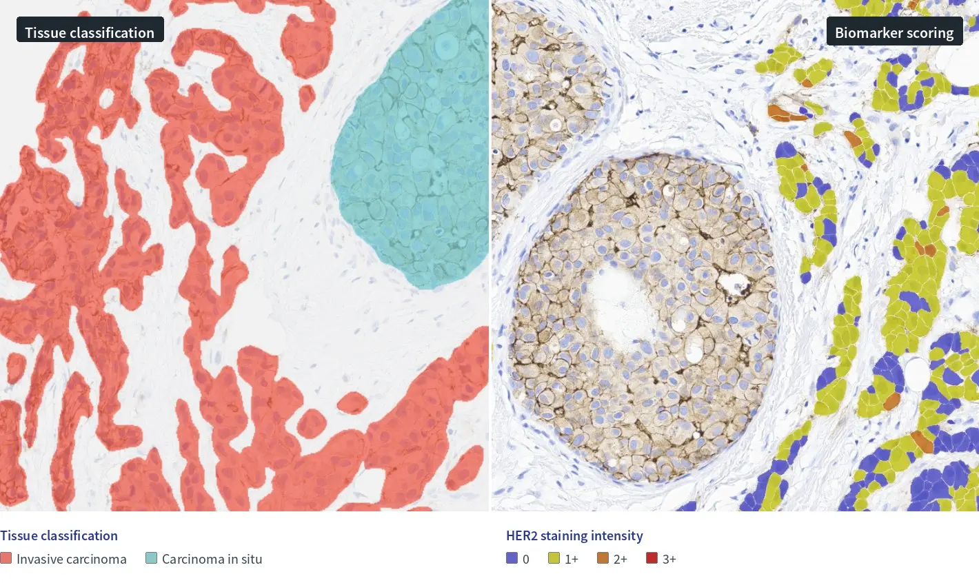breast cancer IHC stain