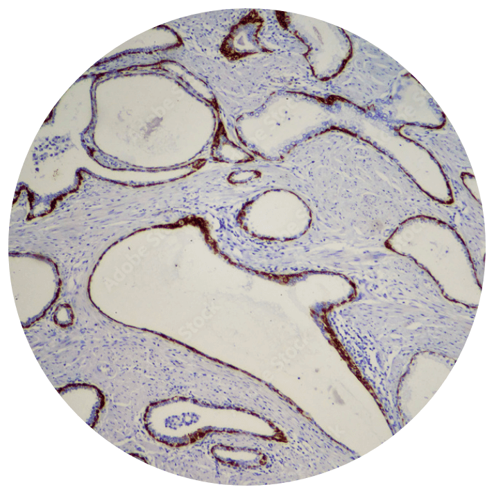 Cancer cells stained on a slide